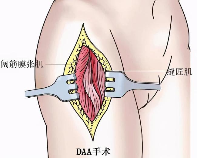 骨折五个月，走路微痛，重拾生活之路的坚韧之旅